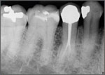 Dental Crowns 2