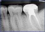 Dental Crowns 5