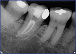 Dental Crowns 5