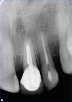 Dental Crowns 5