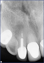 Dental Crowns 5