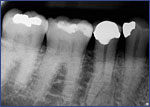 Dental Crowns 1