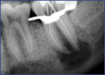 Dental Crowns 4