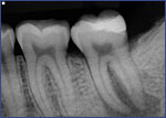 Dental Crowns 3