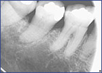 Dental Crowns 5