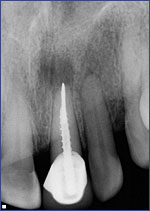 Dental Crowns 5