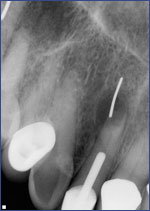 Dental Crowns 5